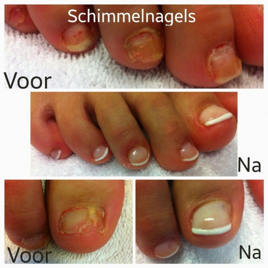 Last van kalknagels? Laserbehandeling voor gezonde en heldere nagels — foto 1