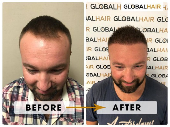 Hoogwaardige Haartransplantatie en Haarimplantatie – GlobalHair