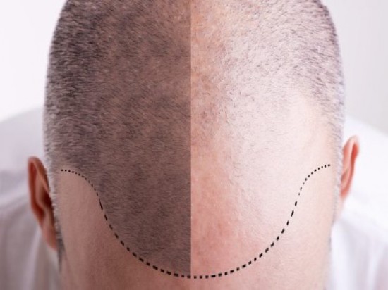 Haartransplantatie in Hoofddorp